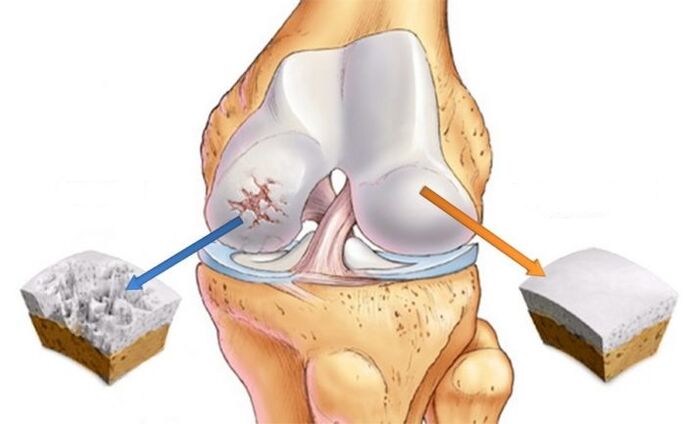 healthy cartilage and arthrosis of the knee