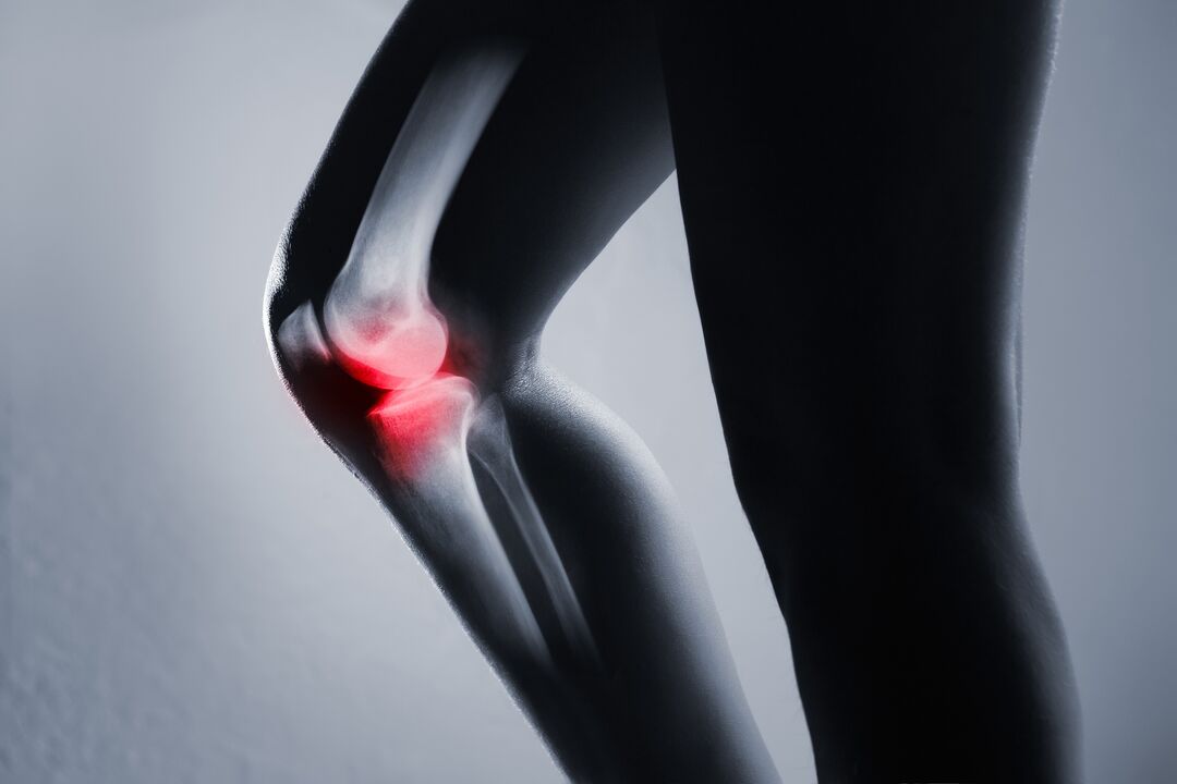 inflammation of the knee joint with arthrosis