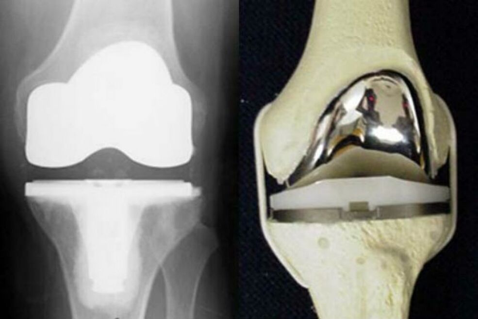 knee joint replacement for arthrosis