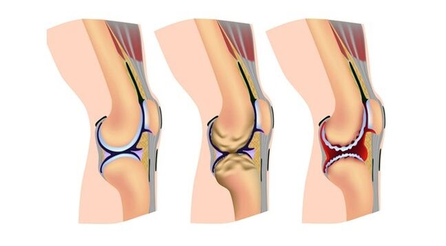 stages of arthrosis of the knee joint