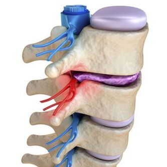 A pinched nerve in the spine is accompanied by shooting pain