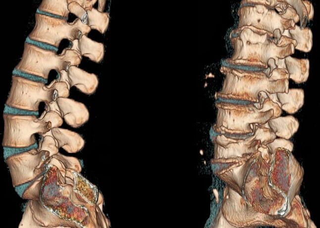 Osteochondrosis of the lumbar region