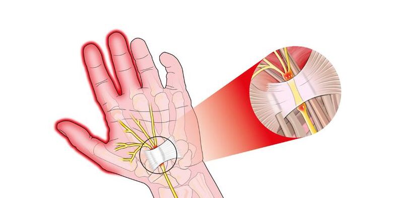 Pain in the joints of the fingers with risartrosis