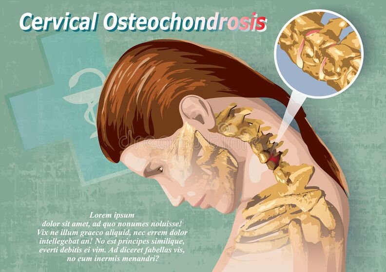 cervical osteochondrosis is a disease of cartilage tissue